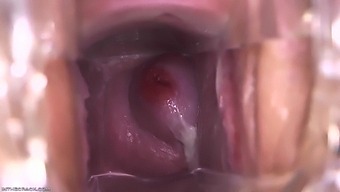 Cervix Cum Glob